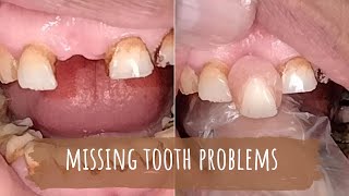 Front tooth replacement  missing tooth  removable tooth  partial tooth [upl. by Elita]