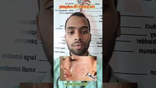 Pimples  Acne Vulgaris Homoeopathic Treatment [upl. by Yecnuahc535]