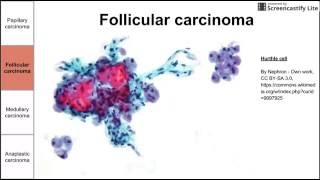 Thyroid Cancers [upl. by Mungovan]