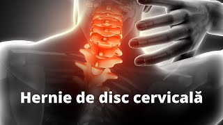 Ce este hernia de disc cervicală kinetoterapie durerecervicala [upl. by Ylrbmik]