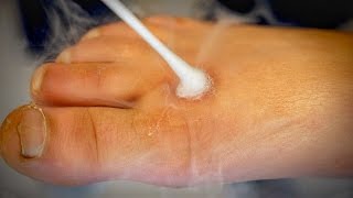 DEEP FREEZING A BIG Crescent Shaped Wart with liquid nitrogen  Dr Paul [upl. by Patterman]