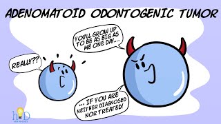 Adenomatoid odontogenic tumor [upl. by Nnyleuqaj492]