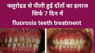 फ्लोराइड से पीली हुई दांतों का इलाज सिर्फ 7 दिन मेंfluorosis teeth treatment yellow teeth [upl. by Atnoid]