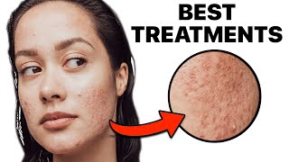 How To Get Rid of Acne Scars [upl. by Ayidan]