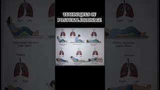 Techniques of Postural Drainage nursingnotesanddiagramhelp nursing medical [upl. by Airemaj]