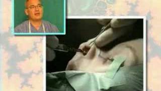 Estetska operacija nosa nose surgery Dr Glusac [upl. by Negah]