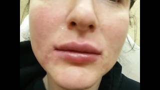 Lip InjectionAugmentation with Juvederm Voluma by Dr Lebowitz Long Island New York [upl. by Gonick102]