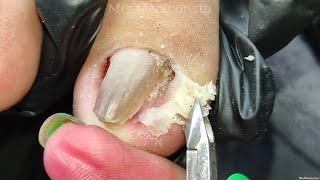 Toenail Ingrown Removal Grabi itong nakuha ko [upl. by Sucy]