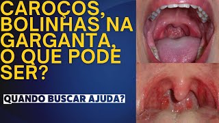 Caroços bolinhas na garganta o que pode ser Quando buscar ajuda caroços garganta faringite [upl. by Ennayhs]