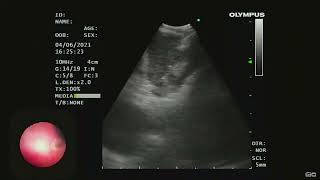 Mediastenal NUT cell carcinoma  Endobronchial Ultrasound EBUS [upl. by Nan]