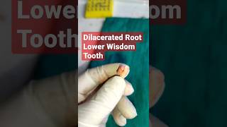 🇳🇵Dilacerated Root Lower Wisdom Tooth Surgical Extraction Dental Clinic in Kathmandu Curved Root [upl. by Lipps683]