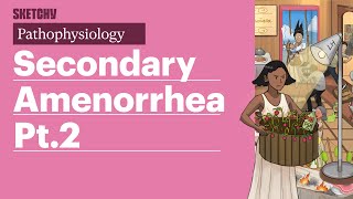 Secondary Amenorrhea Pathophysiology Part 2  Sketchy Medical  USMLE Step 1 [upl. by Stier]