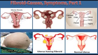 Fibroid Causes Symptoms Part 1 [upl. by Haidabez]