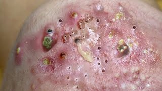 Big Cystic Acne Blackheads Extraction Blackheads amp Milia Whiteheads Removal Pimple Popping  9240 [upl. by Noirod]