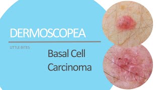 Dermoscopea Little Bites presents Basal Cell Carcinoma [upl. by Judd]