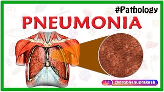 PNEUMONIA  PATHOLOGY ANIMATED VIDEO LECTURE [upl. by Mandy]