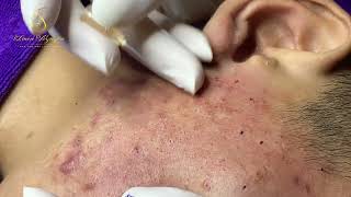 Loan Nguyen Acne Treatment 16288 [upl. by Guilbert]