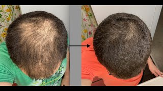 16 Month Finasteride8 Month Minoxidil BeforeAfter [upl. by Enal]