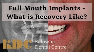 Full Mouth Implants  What is Recovery Like [upl. by Miarzim]