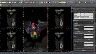 Designing maxillary implant supported overdenture [upl. by Mafala]