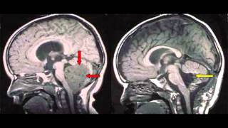 Brain Tumor Overview [upl. by Stig]