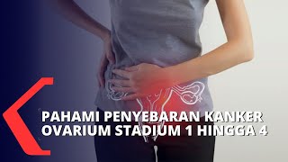 Begini Kondisi Penyebaran Kanker Ovarium Stadium 1 Hingga 4 [upl. by Moyers]