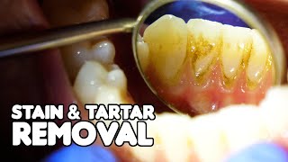 Dental Cleaning EXPLAINED  Stain amp Tartar Removal [upl. by Eeluj]