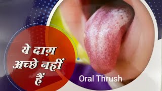 मुँह में फंगस  Oral Thrush  क्या करें fungus mouth health [upl. by Nisay460]