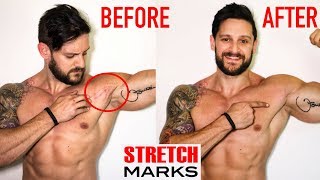 STRETCH MARK REMOVAL  Best Medical To Home Remedies  Why You SHouldnt Be Ashamed  Lex Fitness [upl. by Soigroeg368]