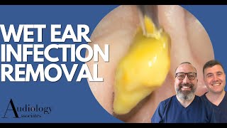 EAR INFECTION REMOVAL EP870 [upl. by Harifaz881]