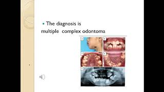 Complex Odontoma [upl. by Devehcoy]