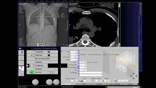 CT Coronary Angio Full Work Process SIEMENS in syngo acquisition workplace [upl. by Baalbeer]