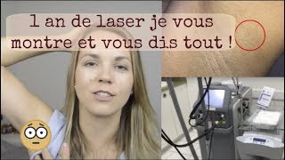 Epilation laser définitive conseils et résultats après un an  Manon Amelie [upl. by Threlkeld506]