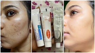 Dermatologist Recommended Best 3 Creams to remove Pimple Marks Acne Scars Dark Spots PIH [upl. by Melvyn]