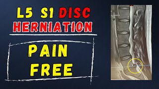 L5 S1 Disc Herniation Recovery without surgery [upl. by Rabin]