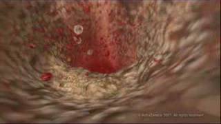 MEDICAL  How cholesterol clogs your arteries atherosclerosis [upl. by Aleen131]