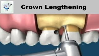 Crown Lengthening Procedure Animation [upl. by Warton233]