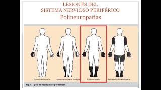 Lesiones del Sistema Nervioso Periférico [upl. by Nerw]