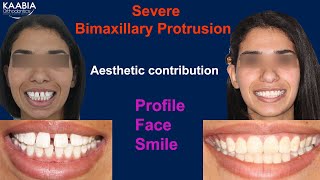 Severe Bimaxillary protrusion  Aesthetic contribution  Profile  Face and Smile [upl. by Melloney299]