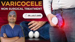 Varicocele Embolization By Dr Lalit Garg Nonsurgical Treatment For Varicocele [upl. by Nalad]