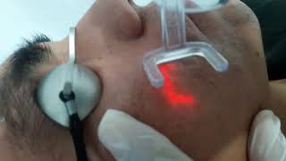 LASER CO2 FRACCIONADO EN CICATRICES DOCTOR CHERNAN ZAPATA MÉDICO DERMATÓLOGO Láser TRUJILLO [upl. by Feucht]