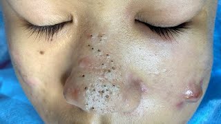 Big Cystic Acne Blackheads Extraction Blackheads amp Milia Whiteheads Removal Pimple Popping  2997 [upl. by Nalaf]