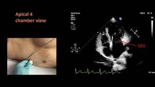 Standard views for a basic echocardiogram [upl. by Nakeber]