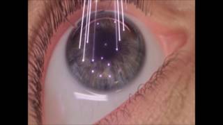 Cirugía Refractiva Lasik con Láser Excimer  Clínica Coro [upl. by Ameerak]