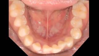 Aggressive periodontitis [upl. by Eisac832]