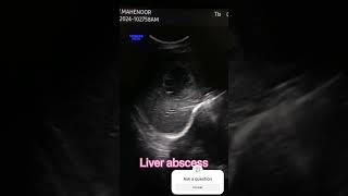 Liver abscess scanning… Subscribe like for ultrasound training medicalstudent radiology [upl. by Retnyw]