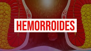 Hemorroides causas diagnóstico síntomas tratamiento y prevención almorranas y sangrado rectal [upl. by Zamir]