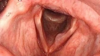 Vocal Cord Cyst Causing Hoarse Voice [upl. by Aday]