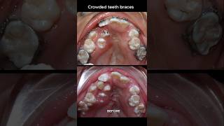 The most crowded teeth ive ever seen braces orthodontist dentist [upl. by Deland]