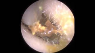 Ear Wax Removal in Narrow Ear Canal using iCLEARscope® endoscope  Mr Neel Raithatha THC [upl. by Oirobil544]